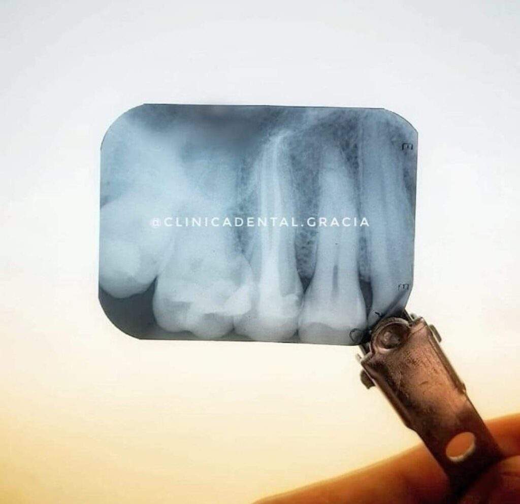 Endodoncia