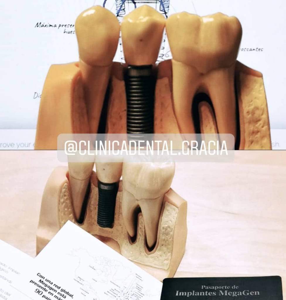 IMPLANTOLOGIA-DENTAL